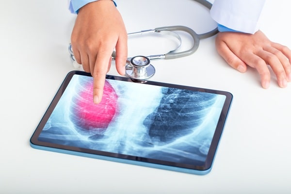 Exames de imagem para pneumonia salvam vidas